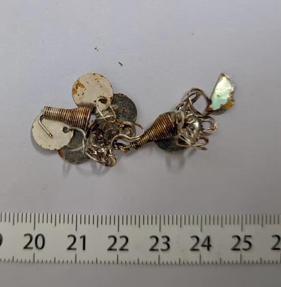 6 माह के शिशु की भोजन नली से निकाला धातु का झूमर