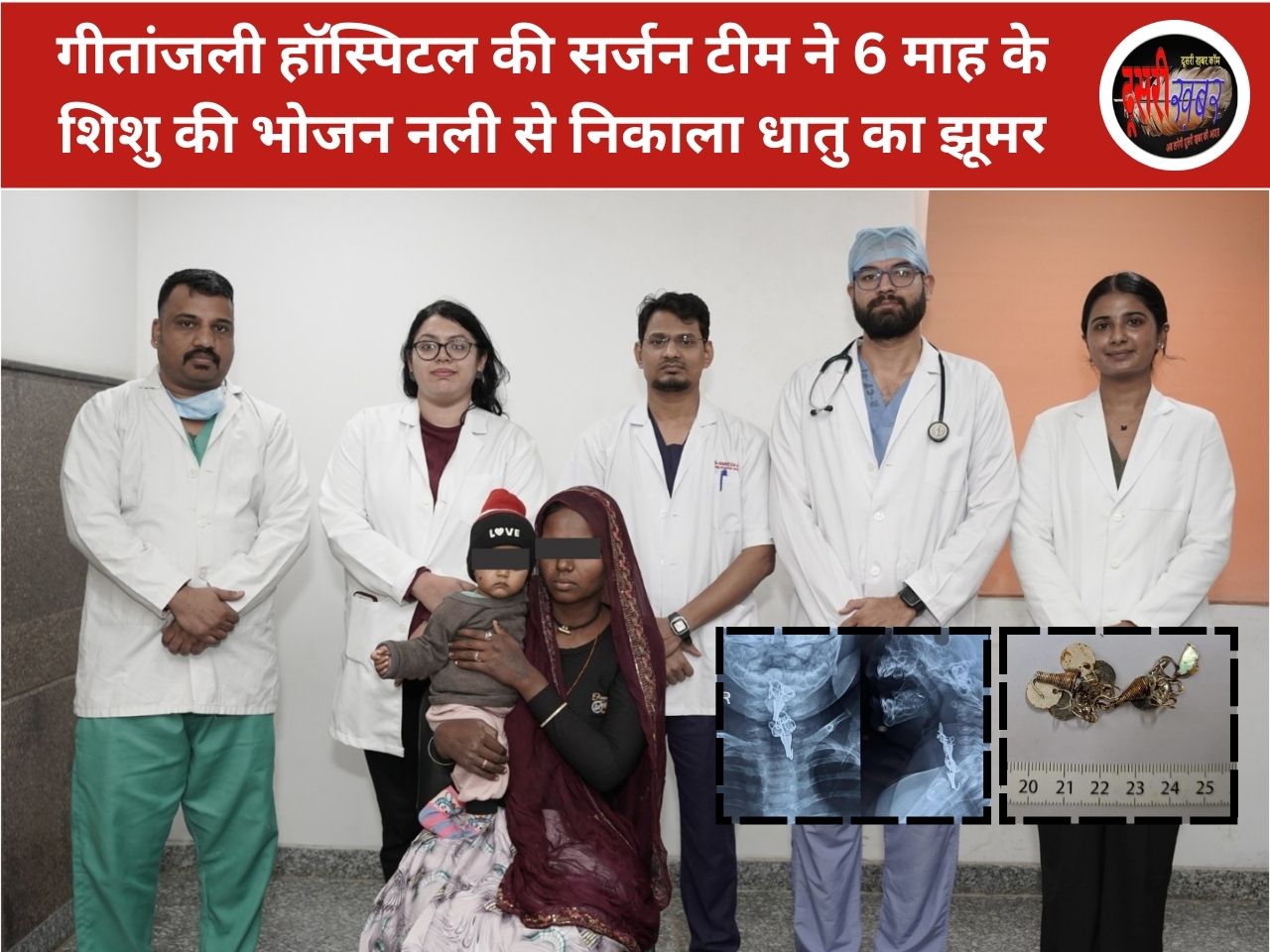 6 माह के शिशु की भोजन नली से निकाला धातु का झूमर 6 माह के शिशु की भोजन नली से निकाला धातु का झूमर