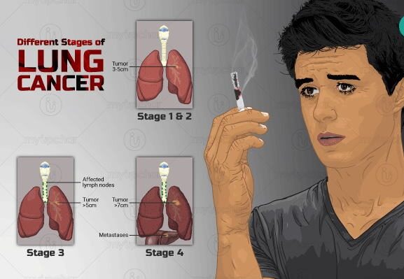 गीतांजली हॉस्पिटल में फेफड़ों के कैंसर पर संगोष्ठी में विशेषज्ञों ने दिए निदान से उपचार तक महत्वपूर्ण सुझाव