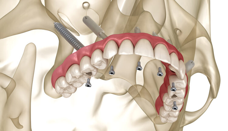 एडवांस्ड जाइगोमैटिक इम्प्लांटोलॉजी