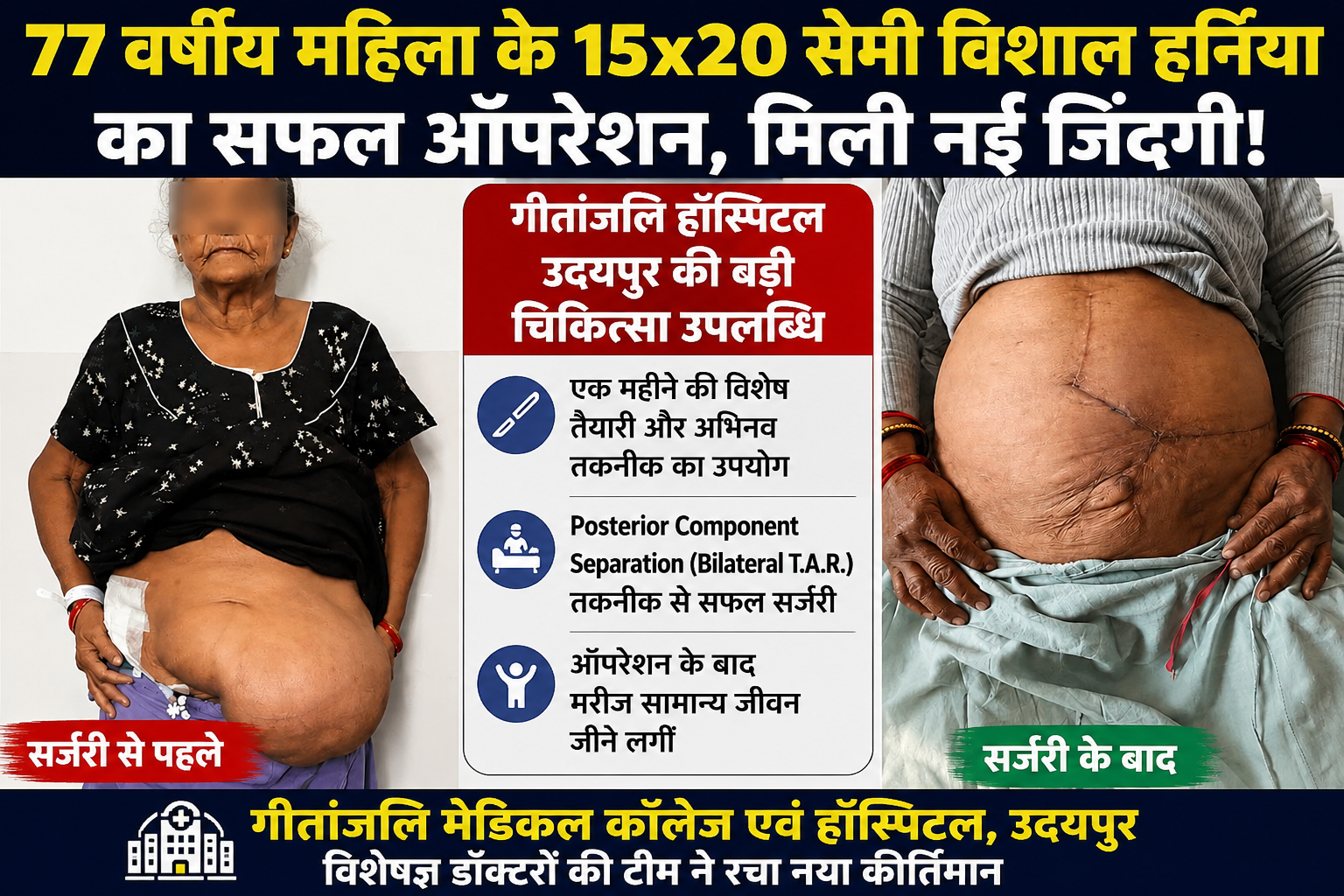 77 वर्षीय महिला के 20 सेंमी. पेचीदा हर्निया का सफल ऑपरेशन, गीतांजली हॉस्पिटल का नया कीर्तिमान…!