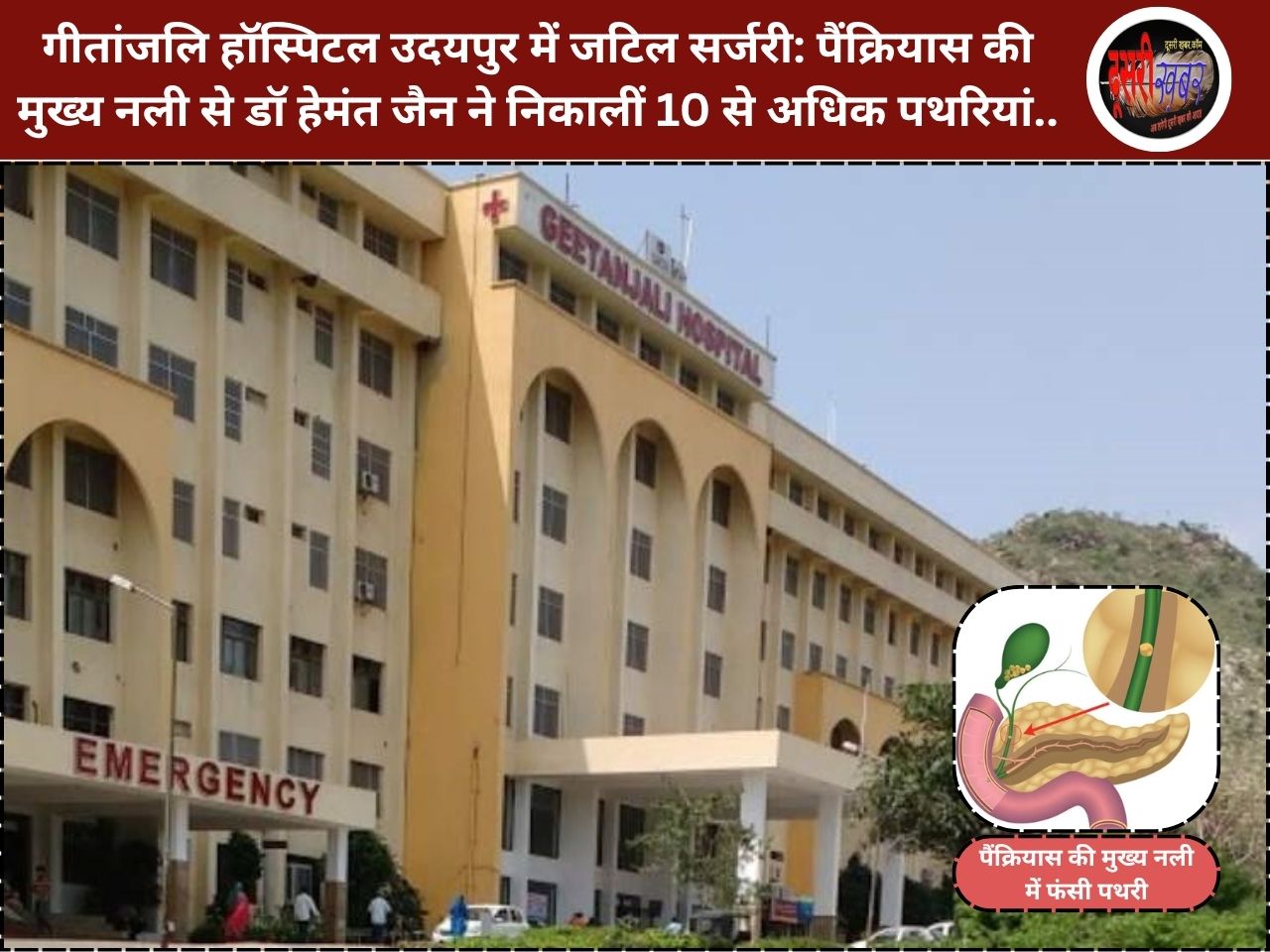 गीतांजलि हॉस्पिटल उदयपुर में जटिल सर्जरी: पैंक्रियास की मुख्य नली से निकालीं 10 से अधिक पथरियां, चौथे दिन छुट्टी गीतांजलि हॉस्पिटल उदयपुर में जटिल सर्जरी: पैंक्रियास की मुख्य नली से निकालीं 10 से अधिक पथरियां, चौथे दिन छुट्टी